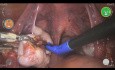 Ovariectomie avec Versius