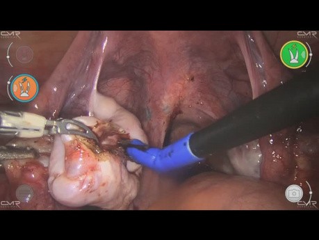 Ovariectomie avec Versius