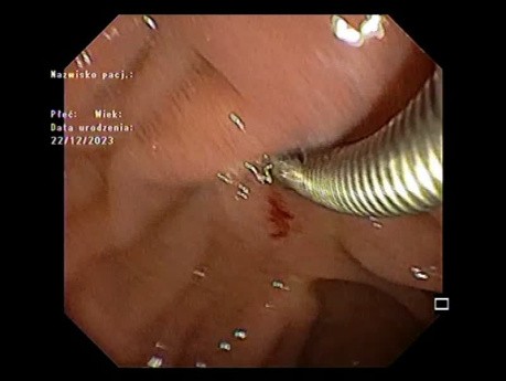 Ampullectomie - Partie V