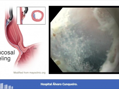 Myotomie endoscopique perorale (POEM) pour le traitement des troubles hypercontractiles de l'œsophage