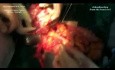 Traitement chirurgical du sarcome abdominal multifocal