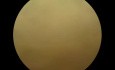Supraglottic Hemangioma
