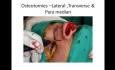 Réduction de Bosse Nasale pour les Débutants en Rhinoplastie - Etape par Etape