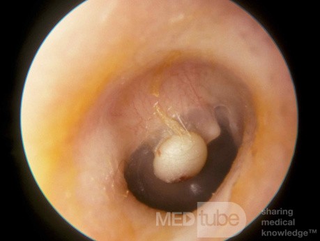 Kyste épidermique de la membrane tympanique