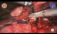 Right Lower Lobectomy with Versius - L Rosso