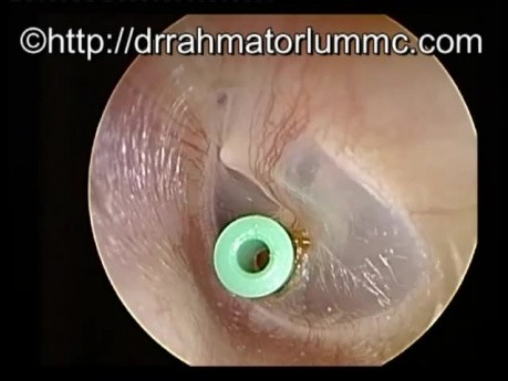 Drain transtympanique In-Situ