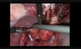 Le retrait de dispositif intra-utérin à partir du rectum par voie laparoscopique