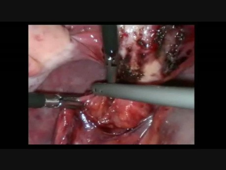 Le retrait de dispositif intra-utérin à partir du rectum par voie laparoscopique