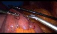 Bypass gastrique par voie cœlioscopique - partie 3