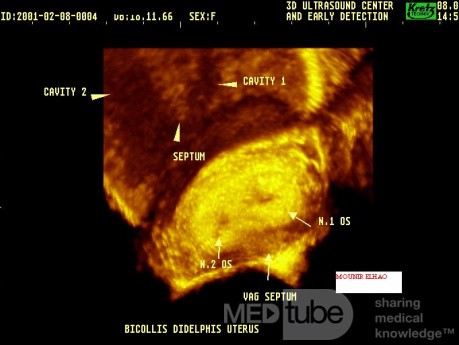L'échographie 3D de l'utérus didelphe .