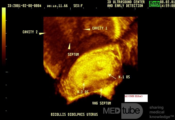L'échographie 3D de l'utérus didelphe .