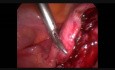 Myomectomie par laparoscopie