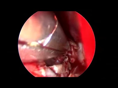 Chirurgie pour l'Atrésie des Choanes 