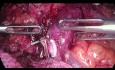 Pancréatectomie totale par laparoscopie pour tumeur de la tête du pancréas