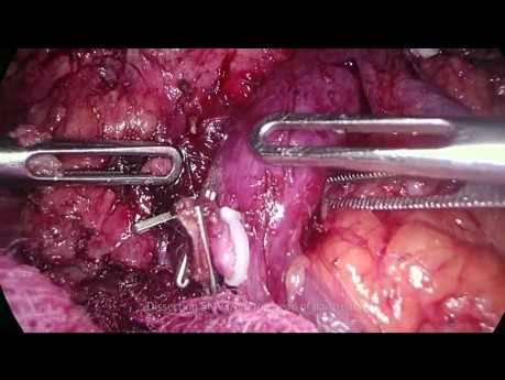 Pancréatectomie totale par laparoscopie pour tumeur de la tête du pancréas