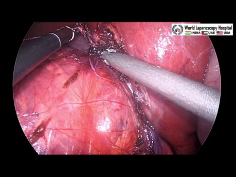 Myolipome de résection laparoscopique de la glande surrénale