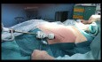 Séparation des Composants Endoscopiques Antérieurs