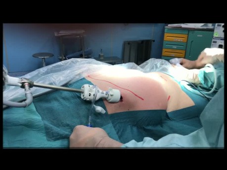 Séparation des Composants Endoscopiques Antérieurs