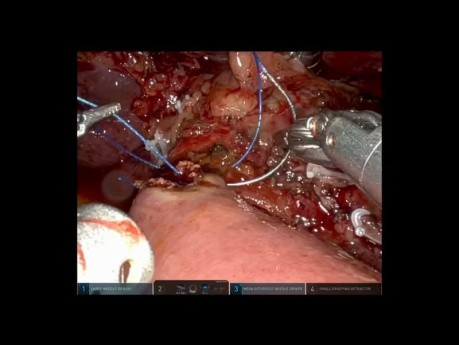 Pancréatico-duodénectomie Robotique avec Antrectomie pour Adénocarcinome Duodénal Localement Avancé