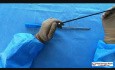 Électrode à crochet pour laparoscopie