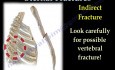 Types de fractures sternales - Conférence vidéo