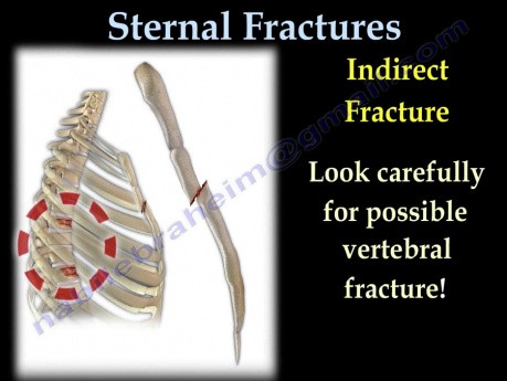 Types de fractures sternales - Conférence vidéo
