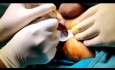 Fistule Anale