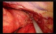 Résection d'un Thymome et Thymectomie par Vidéo-Thoracoscopie Uniportale