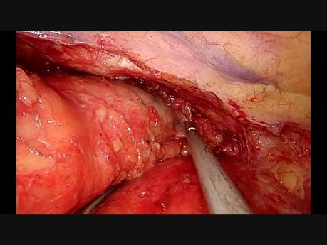 Résection d'un Thymome et Thymectomie par Vidéo-Thoracoscopie Uniportale