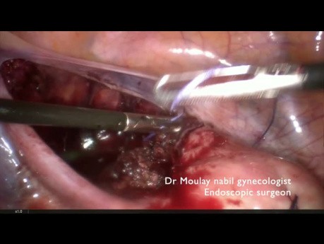 Contrôle Vasculaire Transitoire et Fibrome Cervico-Isthmique