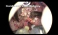 Amygdalectomie - Chirurgie des amygdales