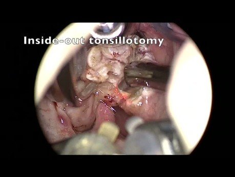 Amygdalectomie - Chirurgie des amygdales