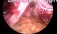 Gastrectomie en manchon par laparoscopie