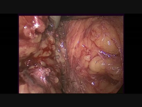 La Résection Antérieure du Rectum. 