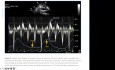 Évaluation Echocardiographique et Diagnostic de la Péricardite Constrictive