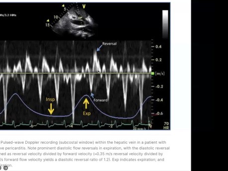 Évaluation Echocardiographique et Diagnostic de la Péricardite Constrictive