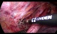Œsophagectomie Thoracoscopique