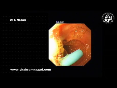Ablation de Prothèse Biliaire