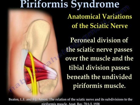 Syndrome du piriforme - conférence vidéo