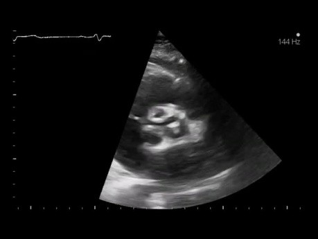 Quiz d'échocardiographie parasternale 2D - vue à l'axe court