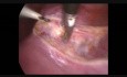 Dissection chirurgicale de la vessie