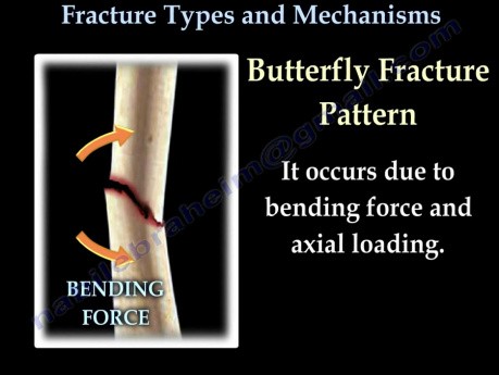 Fractures, types et mécanismes des os de travail