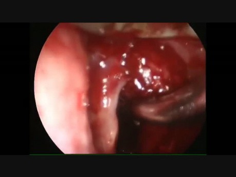 Excision endoscopique du carcinome transglottique