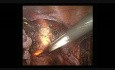 Hystérectomie laparoscopique avec un manipulateur lumineux