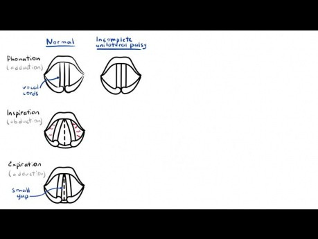 Paralysie du nerf laryngé (anatomie, physiologie, classification, causes, physiopathologie)