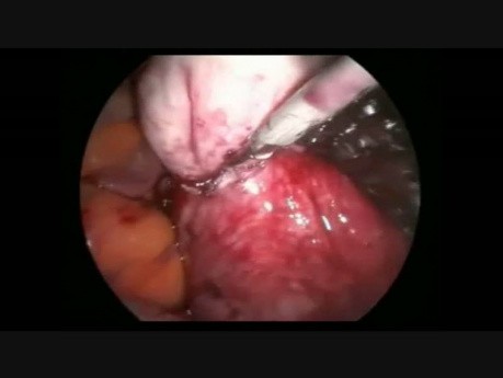 Myomectomie d'un fibrome dans la paroi postérieure par laparoscopie