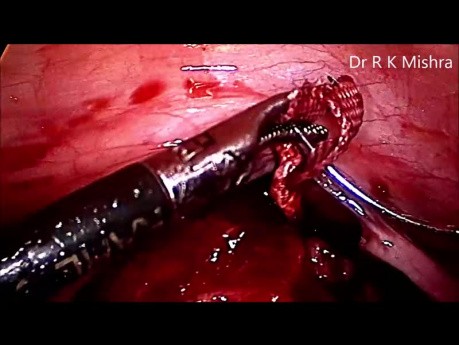 Cerclage du col utérin par voie laparoscopique