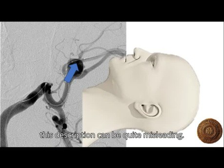 Direction du Fundus Anévrismal