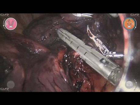 Right Middle Lobectomy with Versius – Patrick Bagan
