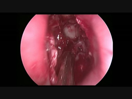 Excision chirurgicale de l'ostéome du sinus frontal via Draf IIb